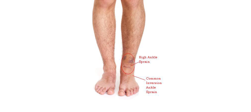 high ankle sprain labelled