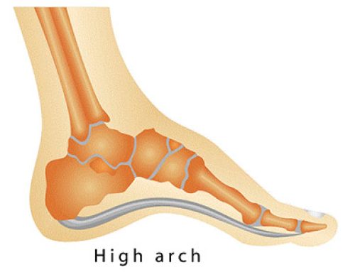 Flat Feet & Arch Pain: The Tibialis Posterior Connection