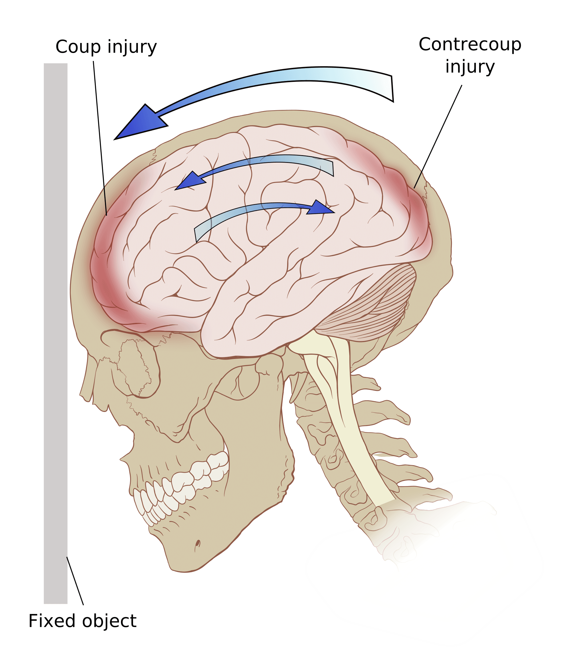 A brain injury occuring