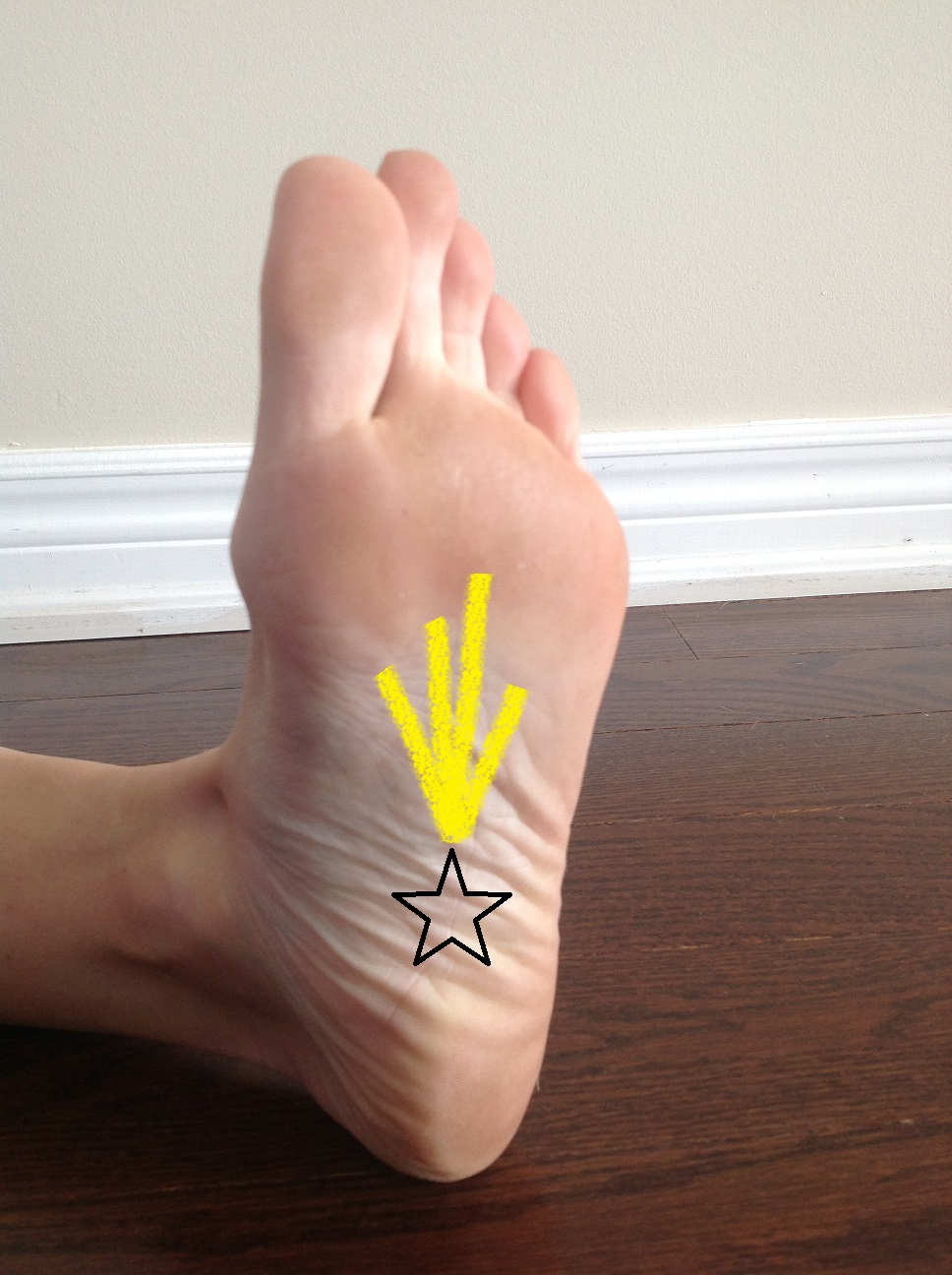 Plantar Fasciitis and Other Abnormalities of the Plantar Fascia