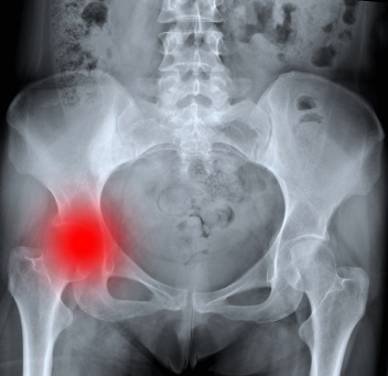 x-ray of hip pain