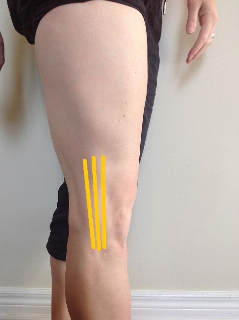 IT Band Syndrome - Running Injury Treatment in Burlington ON