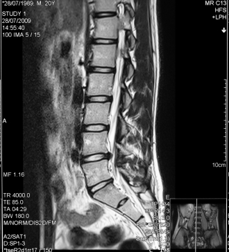 x-ray of sciatica skeleton
