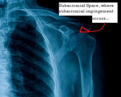 subacromial space on an xray