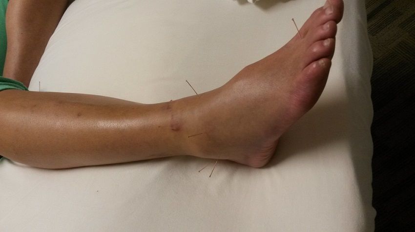 acupuncture needles in foot and ankle