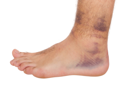 Ankle Sprain with bruising around ankle