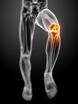 Runner skeleton with knee pain