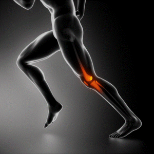 Pain in the front of the knee - Patellofemoral Pain Syndrome