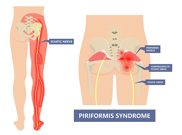 Piriformis syndrome pain