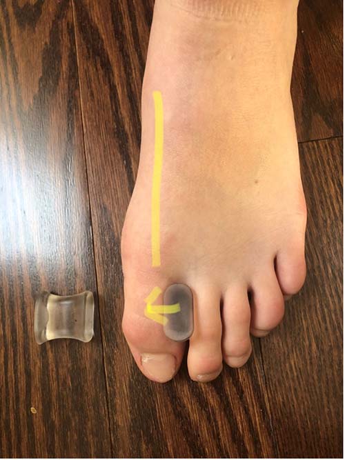 toe spacer for bunion