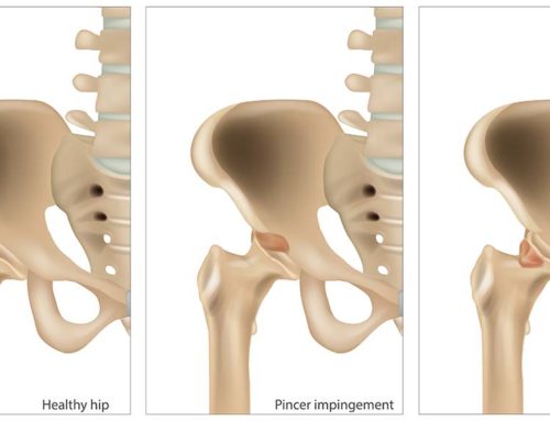 Femoroacetabular Impingement (FAI) and Hip Pain