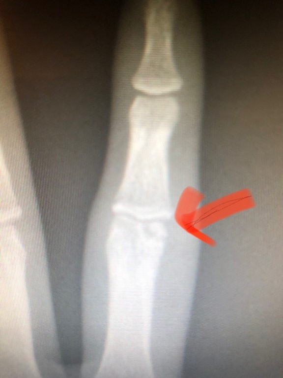 x-ray of arthritis